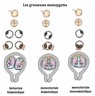 grossesse monochoriale monoamniotique